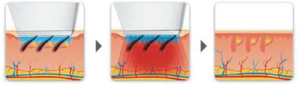 laser 808 manipolo fasi